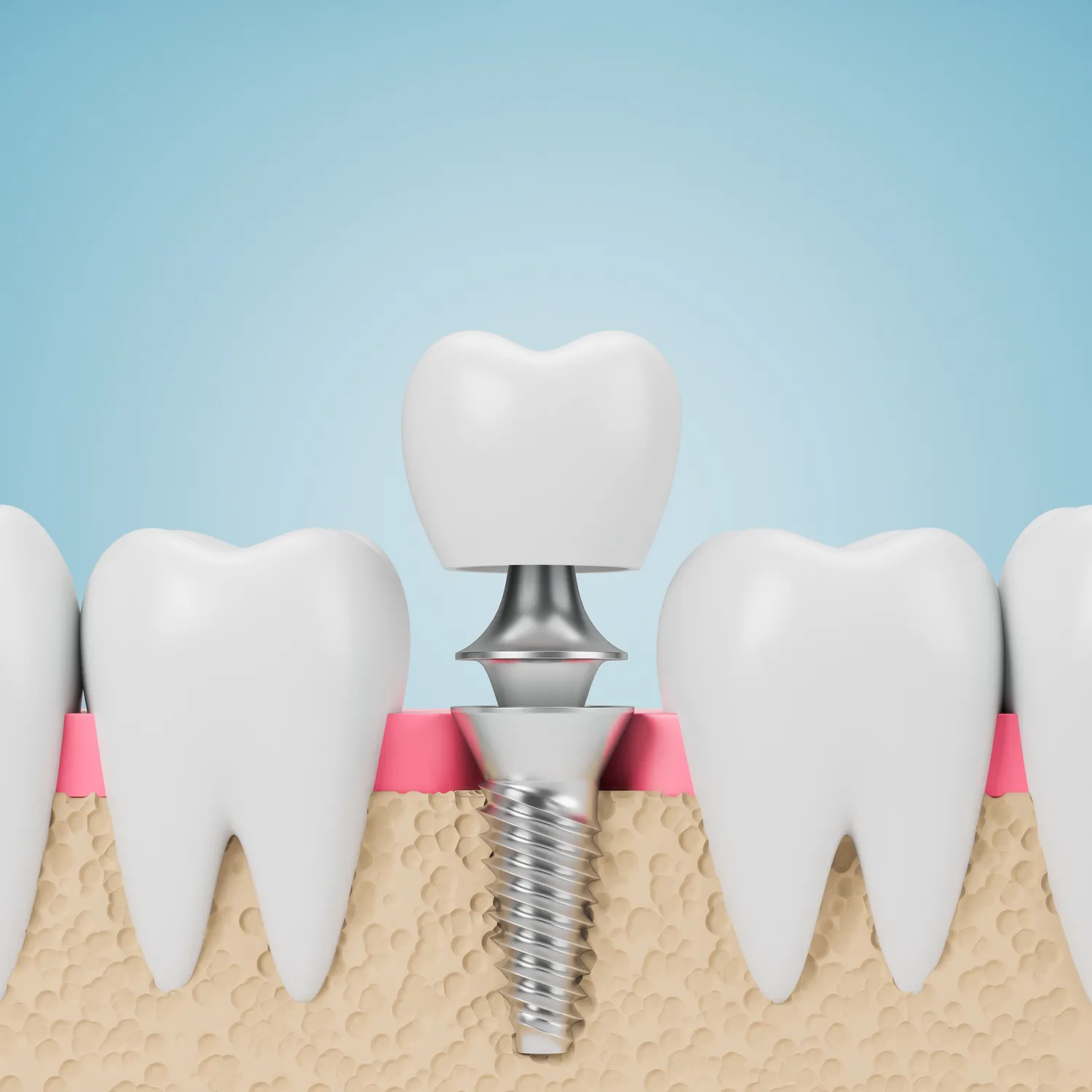 Implanty dentystyczne Szczecin