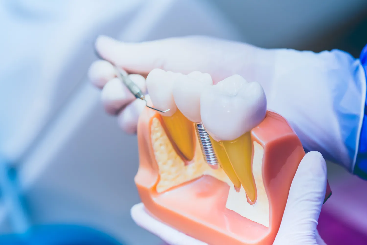 Jak wygląda zabieg wszczepiania implantów zębowych?