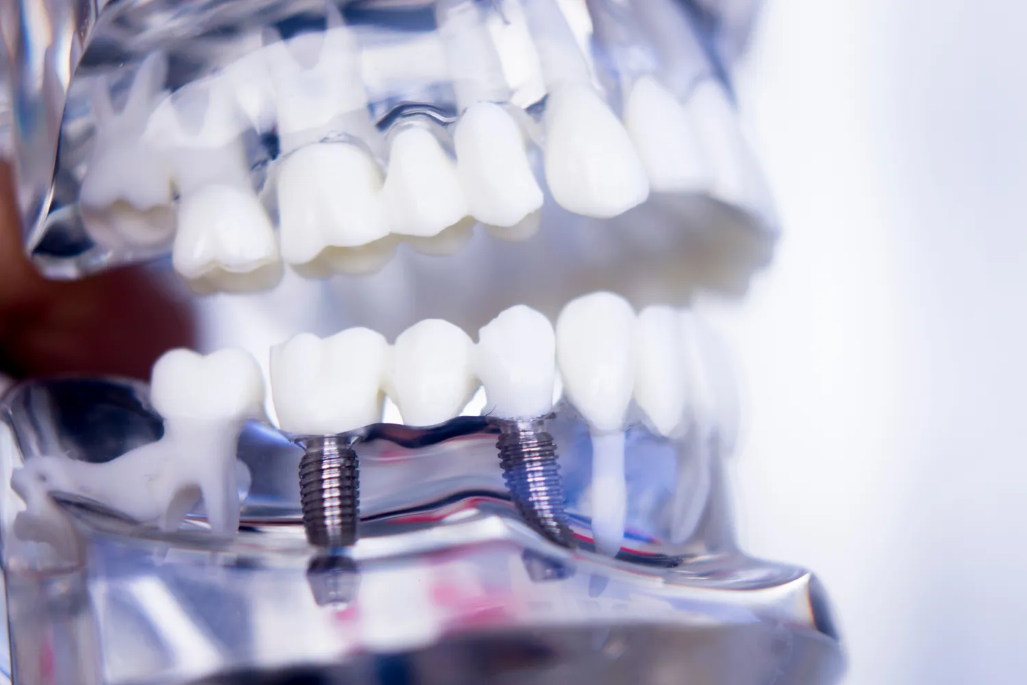 Jakie są rodzaje implantów zębowych?