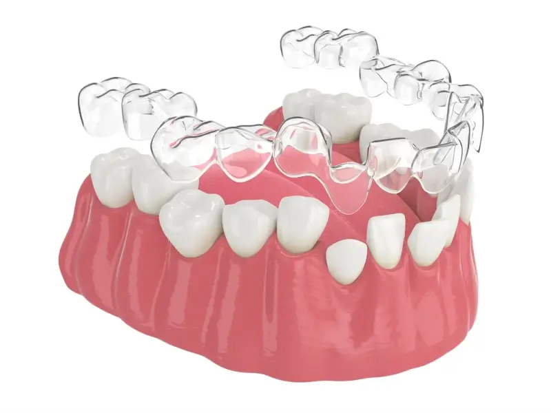 Invisalign kiedy pierwsze efekty?