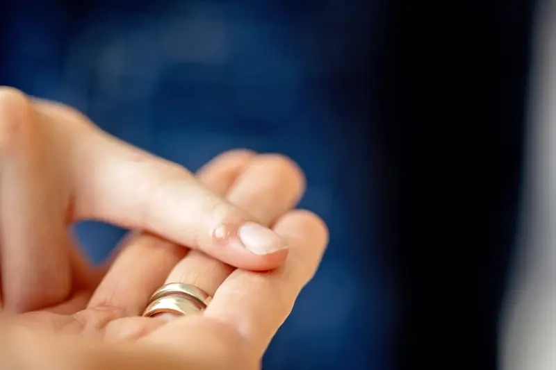 Jak wygląda początek kurzajki?